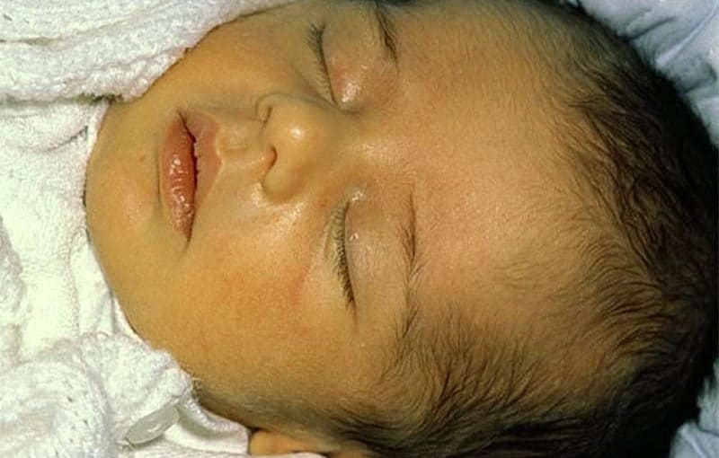 ما هي أعراض أبو صفار (اليرقان) عند الأطفال واخطر انواعه