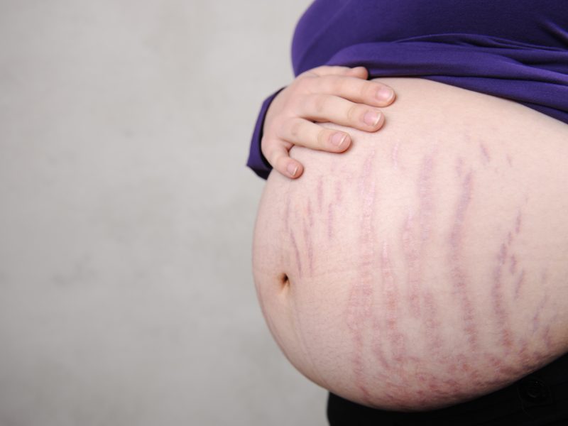 وصفات طبيعية تساعد على تبييض البطن بعد الولادة بدون آثار جانبية أو تكاليف مادية